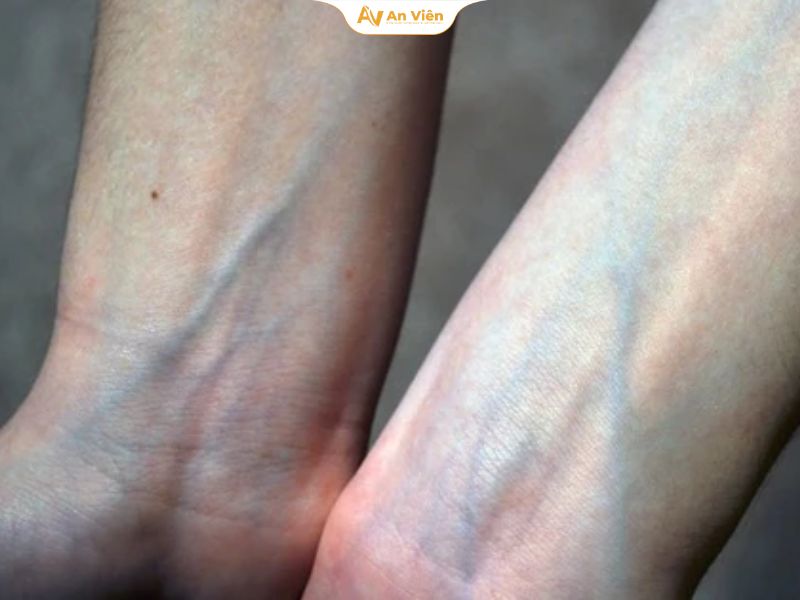 Nổi gân xanh ở cánh tay