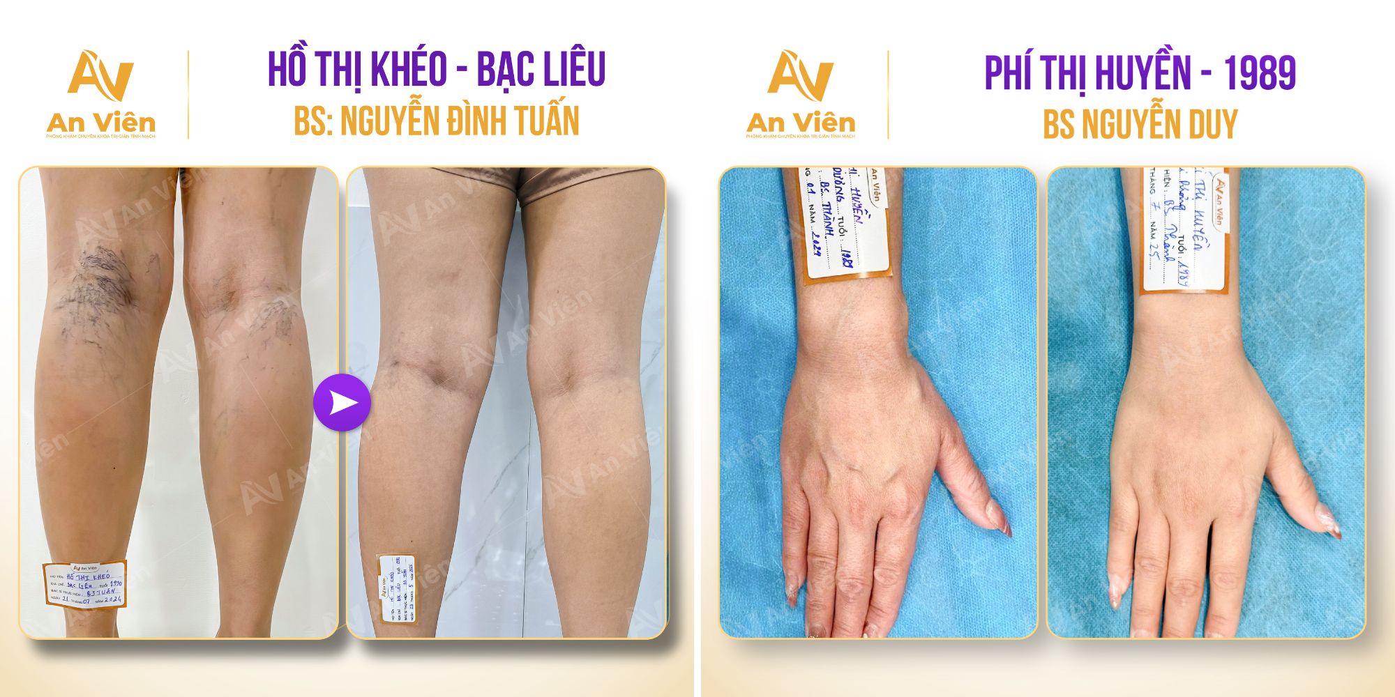 Nổi gân xanh ở tay và chân: Giải pháp điều trị hiệu quả từ chuyên gia An Viên 12 Nổi gân xanh ở tay và chân