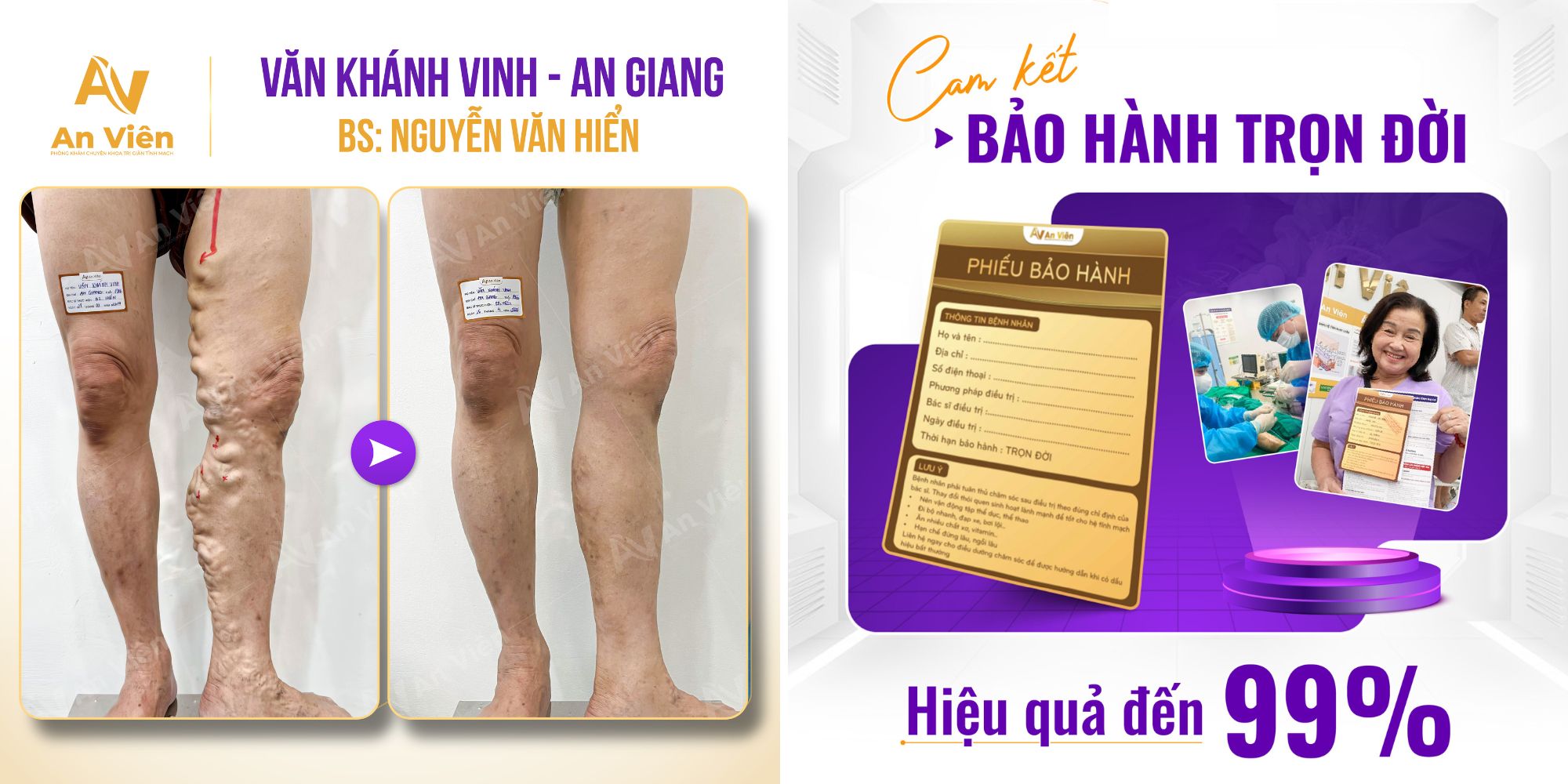 Suy giãn tĩnh mạch