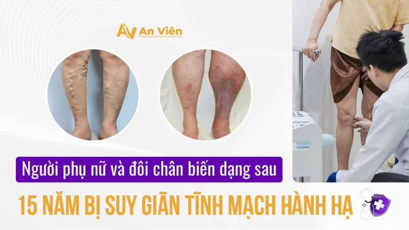 Người phụ nữ và đôi chân biến dạng sau 15 năm bị suy giãn tĩnh mạch hành hạ 3 doi-chan-bien-dang