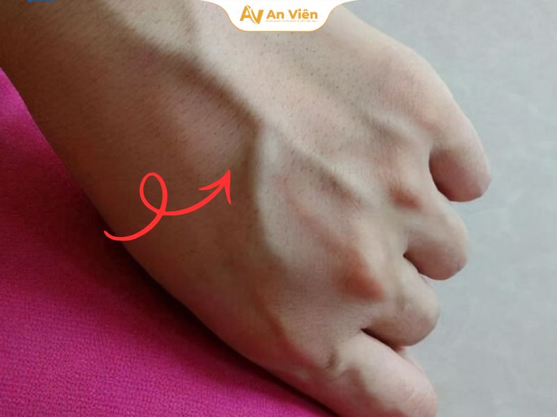 Gân tay màu xanh dương là gì? Có nguy hiểm không? 7 gan-tay-mau-xanh-duong-la-gi