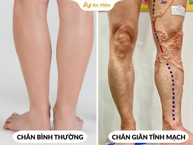 Suy giãn tĩnh mạch: Không chỉ gây đau mà còn âm thầm hủy hoại vẻ đẹp đôi chân 6 gan-xanh-o-chan