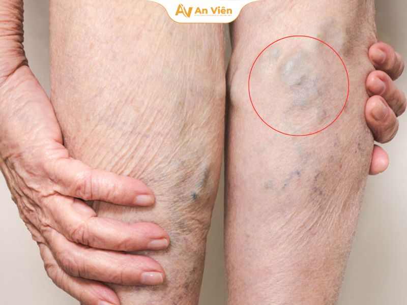 Gân xanh ở chân làm mất tự tin? 3 cách điều trị giúp chân mượt lại như ban đầu 5 gan-xanh-o-chan