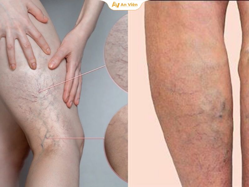 Cảnh báo những sai lầm khi tự chữa giãn tĩnh mạch người bệnh cần tránh 8 Bệnh giãn tĩnh mạch chân