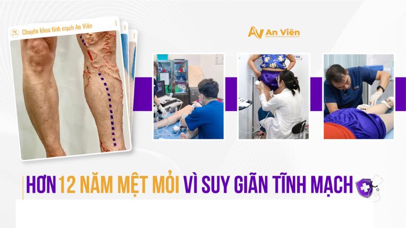 Hơn 12 năm mệt mỏi vì suy giãn tĩnh mạch, người phụ nữ tìm lại đôi chân khỏe mạnh tại An Viên 2 suy gian tinh mach 1 1