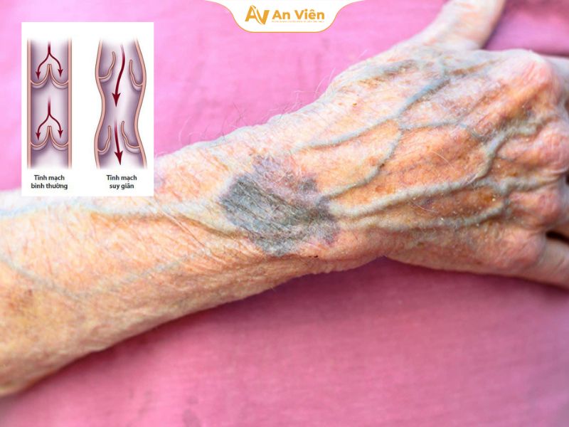 Gân tay màu xanh dương là gì? Có nguy hiểm không? 10 tai-sao-tay-noi-gan-xanh