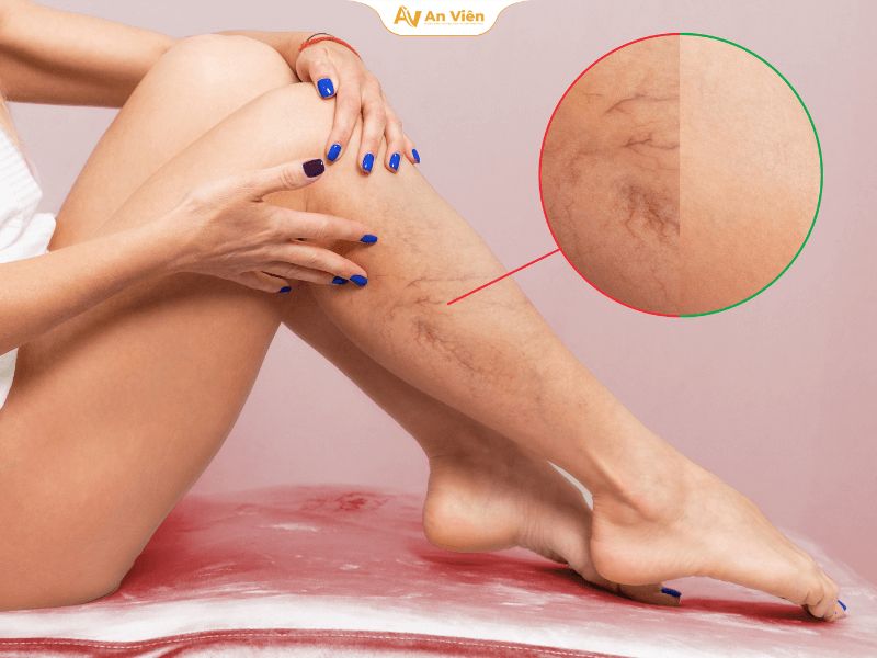Tĩnh mạch nổi trên da: Dấu hiệu bình thường hay bệnh lý cần điều trị? 8 Tĩnh mạch nổi trên da chân