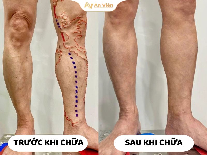 kham-tinh-mach-an-vien