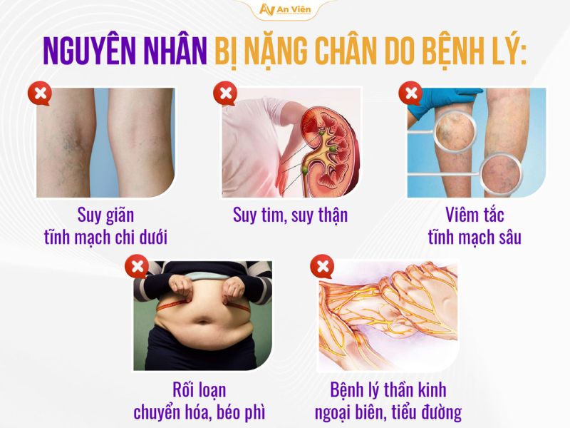 Bị nặng chân