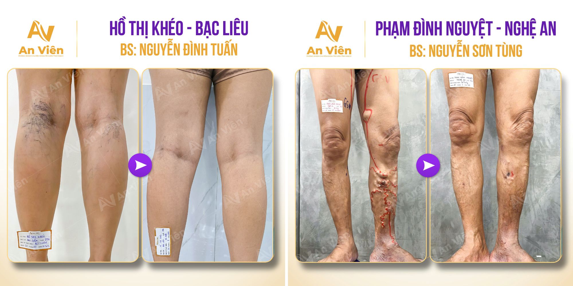 Chuyên gia An Viên giải đáp: Chi phí điều trị suy giãn tĩnh mạch phụ thuộc vào điều gì? 5 Chi phí điều trị suy giãn tĩnh mạch