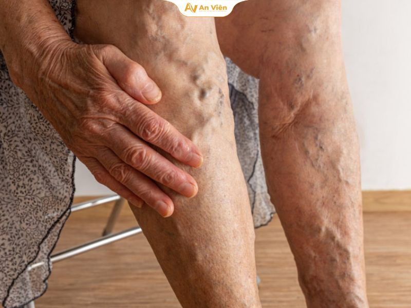 Bệnh giãn tĩnh mạch ở người già: Nhận biết, điều trị và phòng ngừa 14 Bệnh giãn tĩnh mạch ở người già có nguy hiểm không?