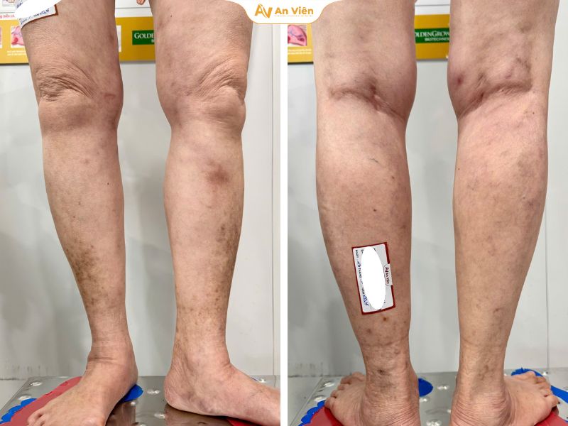 Giai đoạn và mức độ suy giãn tĩnh mạch