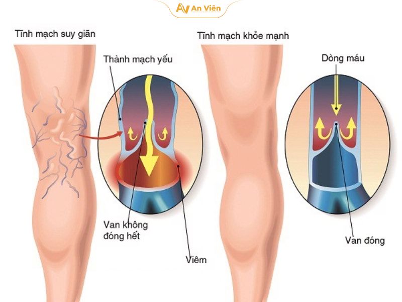 Chữa giãn tĩnh mạch bằng diện chẩn