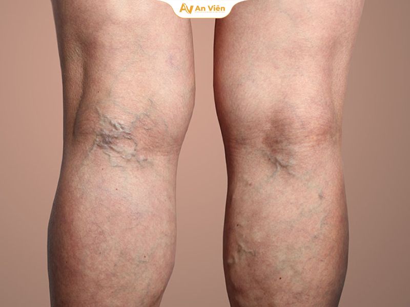 Chữa giãn tĩnh mạch bằng diện chẩn