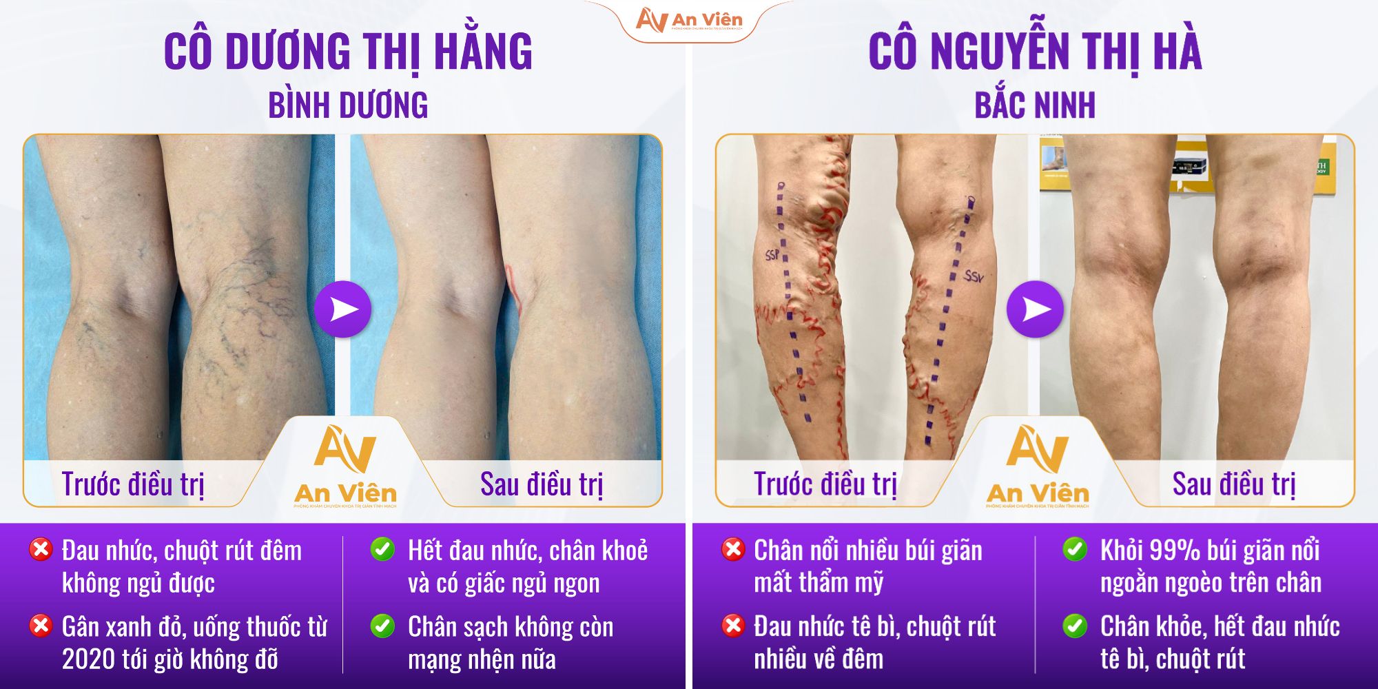 Nỗi sợ tái phát suy giãn tĩnh mạch ám ảnh người bệnh sau điều trị 11 Suy giãn tĩnh mạch