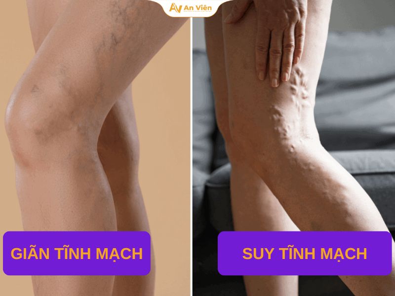 Suy tĩnh mạch khác giãn tĩnh mạch