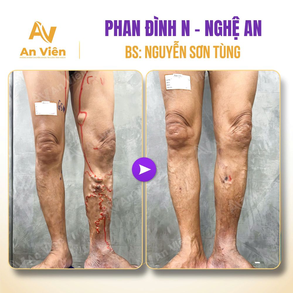 Từ mỏi chân đến biến chứng tĩnh mạch: Cái giá của việc chủ quan 6 Tĩnh mạch