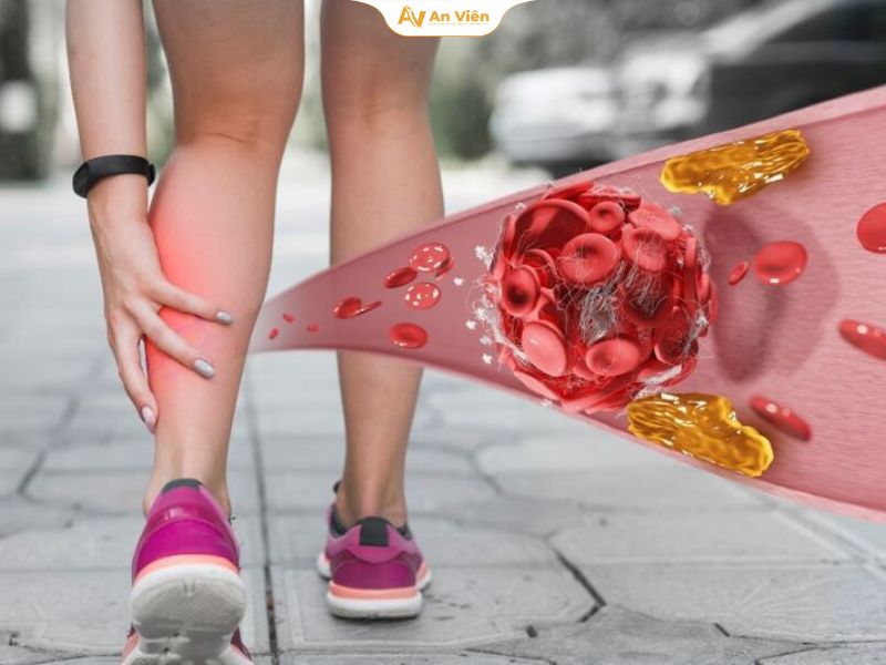 Bệnh mạch máu ngoại biên là gì?
