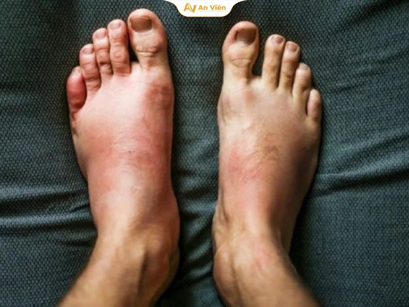 Ngồi lâu chân bị phù là gì? Nguyên nhân và cách phòng tránh 15 Đau chân hoặc cảm giác căng tức rõ rệt