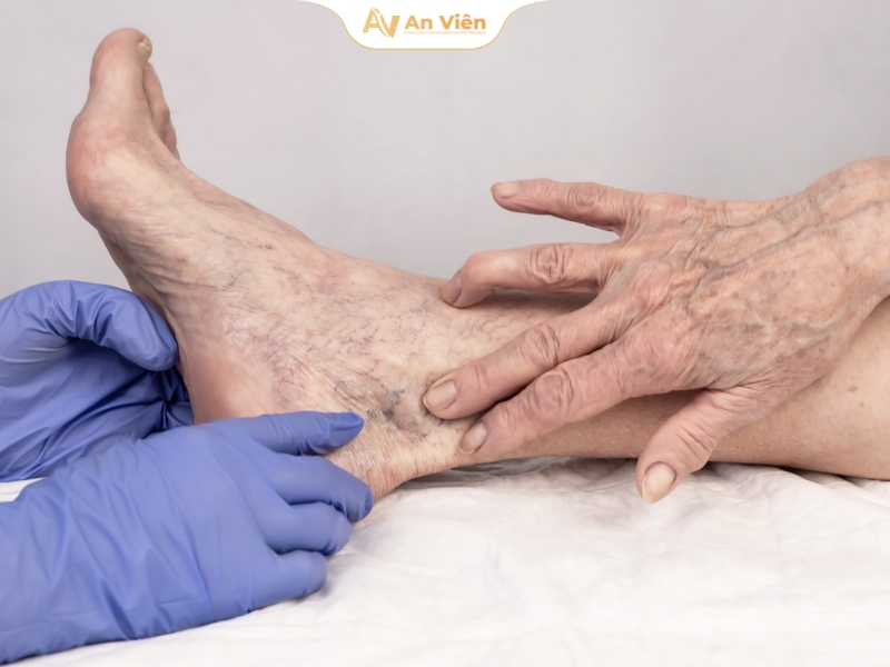 Nổi mạch xanh dưới da: Không chỉ là chuyện thẩm mỹ 5 noi-mach-xanh-duoi-da