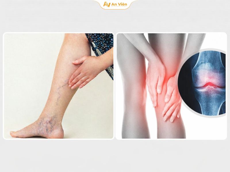 Phân biệt giãn tĩnh mạch và bệnh xương khớp 13 Phân biệt giãn tĩnh mạch và bệnh xương khớp