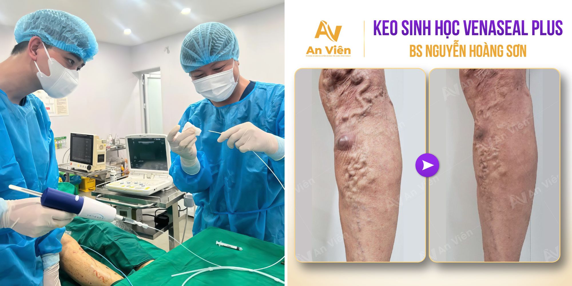 Vỡ tĩnh mạch có nguy hiểm không? Cảnh báo từ bác sĩ chuyên khoa 15 Keo sinh học Venaseal