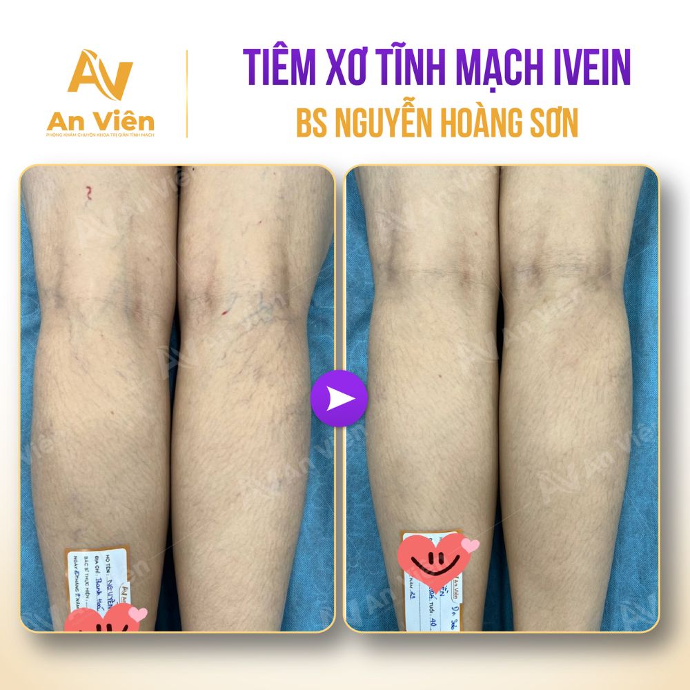 Mới 35 đã thấy gân xanh, nổi tĩnh mạch nông – Đừng xem nhẹ dấu hiệu này 8 Gân xanh
