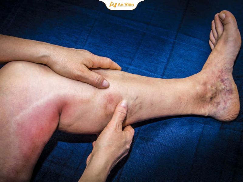 Phác đồ điều trị huyết khối tĩnh mạch: Cập nhật đầy đủ, dễ hiểu cho người bệnh 12 Phác đồ điều trị huyết khối tĩnh mạch