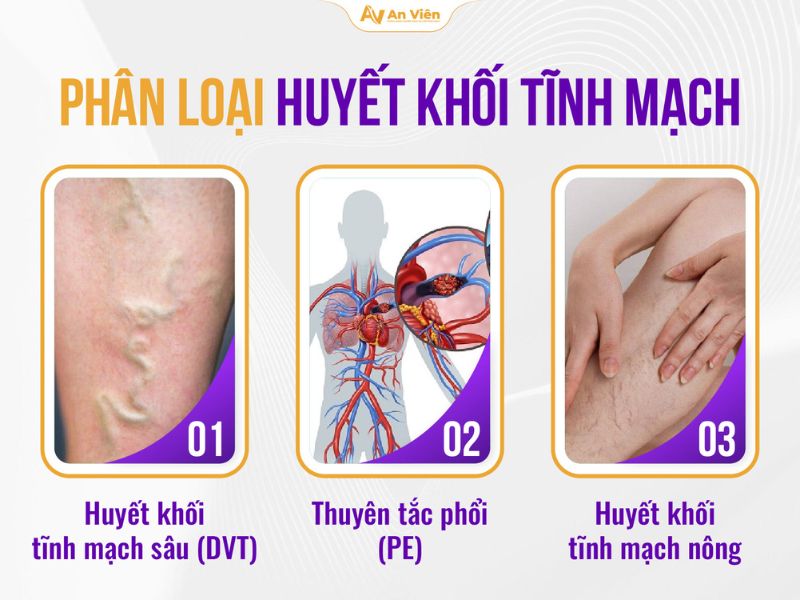 Phác đồ điều trị huyết khối tĩnh mạch: Cập nhật đầy đủ, dễ hiểu cho người bệnh 13 Phác đồ điều trị huyết khối tĩnh mạch