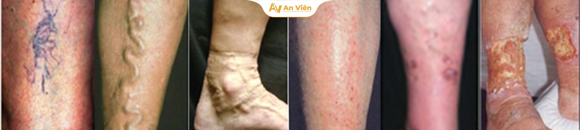 Phác đồ điều trị huyết khối tĩnh mạch: Cập nhật đầy đủ, dễ hiểu cho người bệnh 14 Phác đồ điều trị huyết khối tĩnh mạch