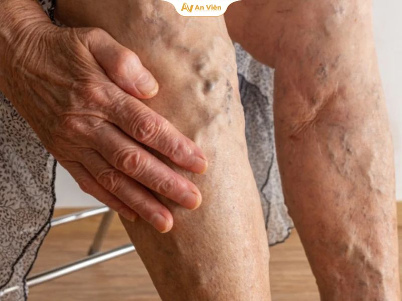 Phác đồ điều trị huyết khối tĩnh mạch: Cập nhật đầy đủ, dễ hiểu cho người bệnh 19 Phác đồ điều trị huyết khối tĩnh mạch