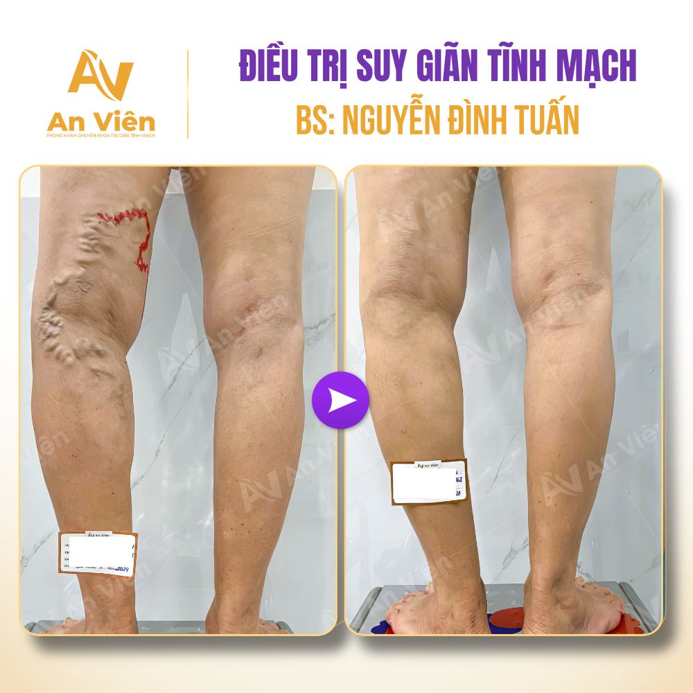 Suy giãn tĩnh mạch
