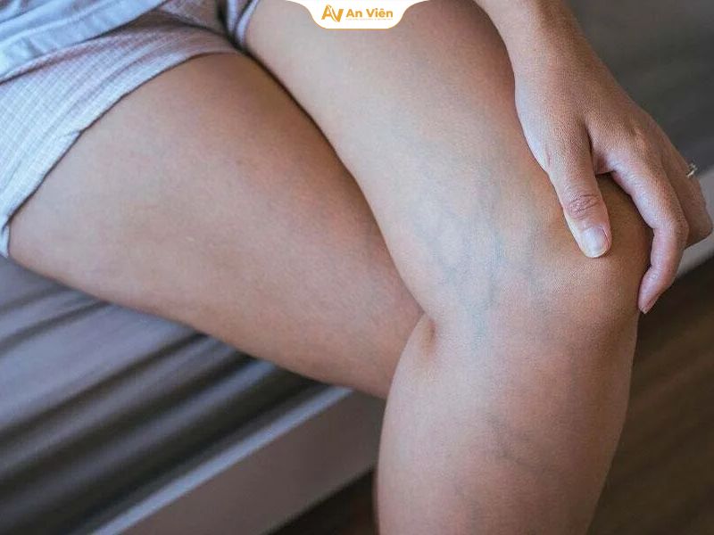 Tại sao chân nổi gân xanh và cách nhận biết sớm nguy cơ bệnh 10 Tại sao chân nổi gân xanh
