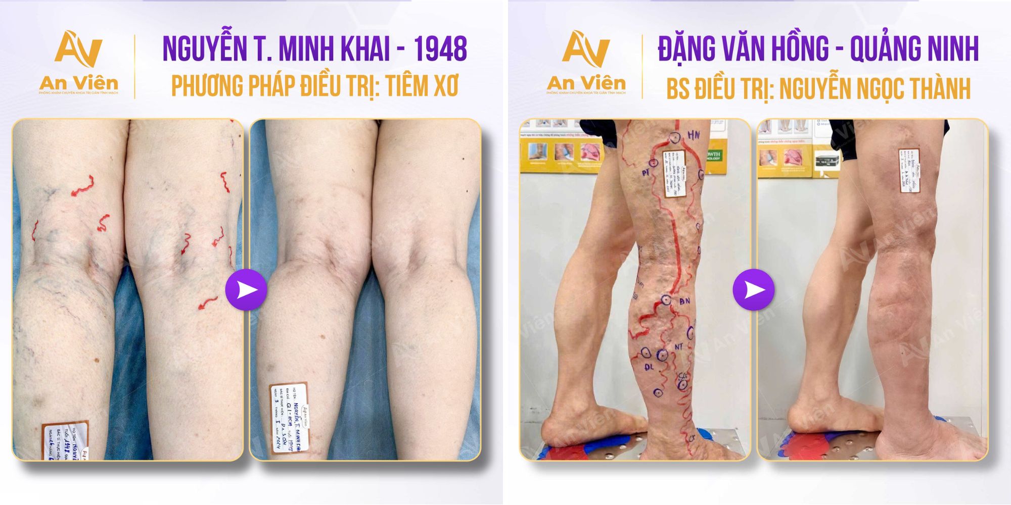 Thuốc xịt trị giãn tĩnh mạch