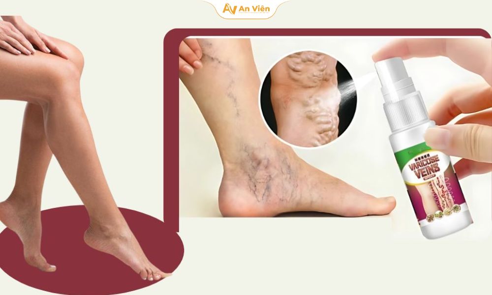 Thuốc xịt trị giãn tĩnh mạch