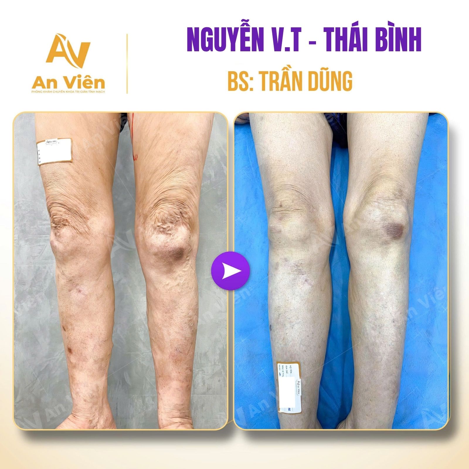 Biến chứng