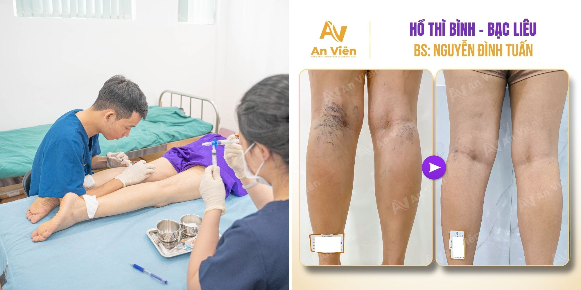Giãn tĩnh mạch nhẹ có chữa được không? Trao đổi cùng bác sĩ 11 Giãn tĩnh mạch nhẹ có chữa được không