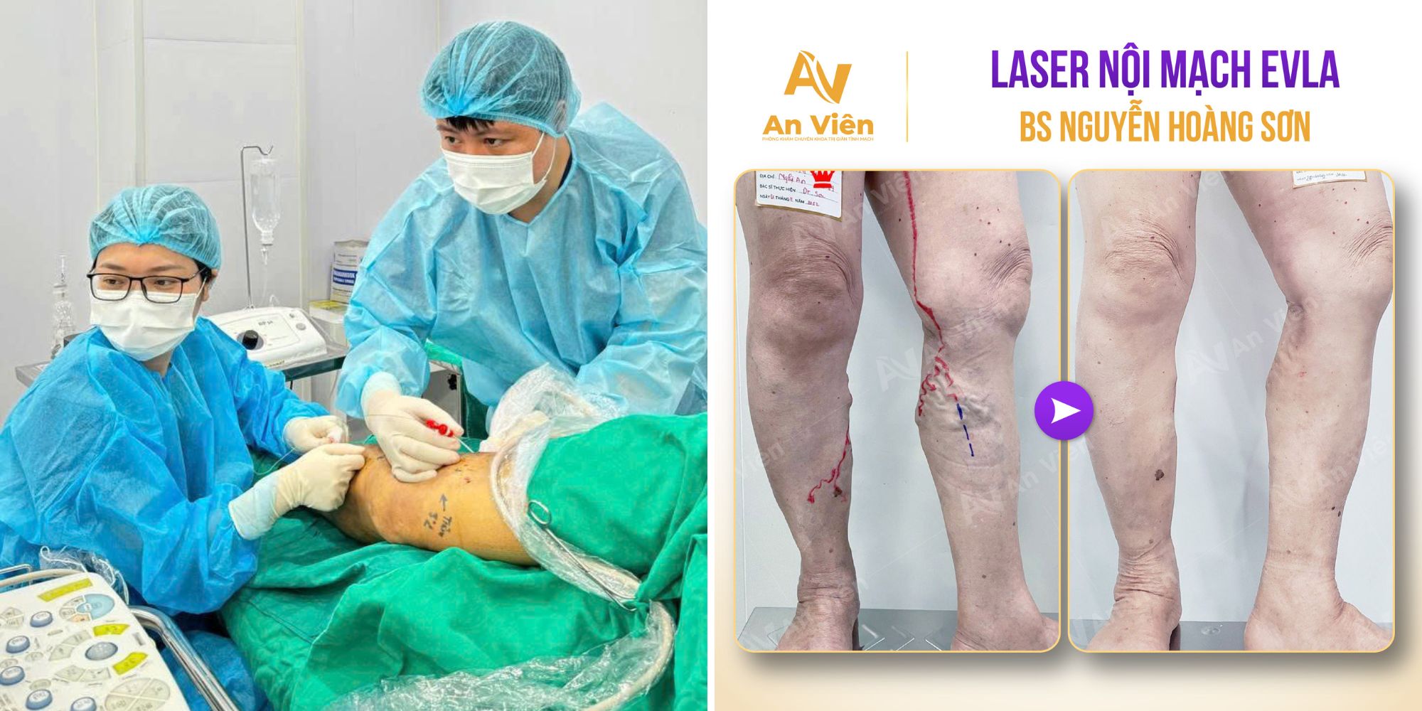 Giãn tĩnh mạch nhẹ có chữa được không? Trao đổi cùng bác sĩ 12 Giãn tĩnh mạch nhẹ có chữa được không