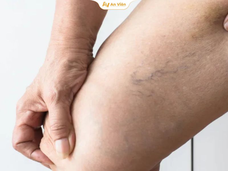 Giãn tĩnh mạch nhẹ có chữa được không? Trao đổi cùng bác sĩ 9 Giãn tĩnh mạch nhẹ có chữa được không
