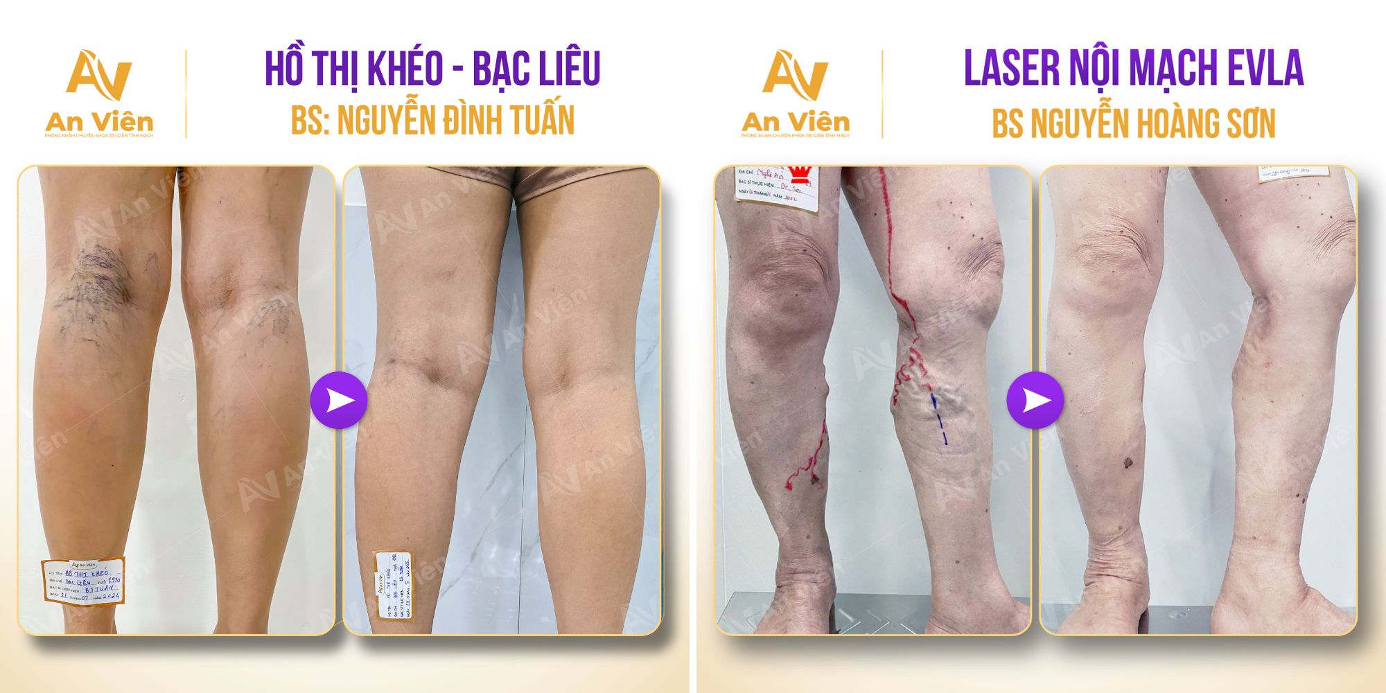 Giãn tĩnh mạch ở giáo viên: Bệnh nghề nghiệp dễ bị bỏ qua 15 Giãn tĩnh mạch ở giáo viên