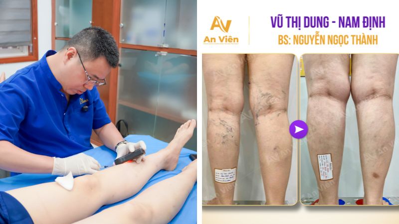 Gối kê chân giãn tĩnh mạch Ema