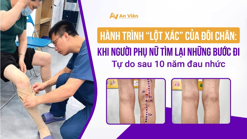 Hành trình “lột xác” của đôi chân: Khi người phụ nữ tìm lại những bước đi tự do sau 10 năm đau nhức 4 cach deo vo gian tinh mach