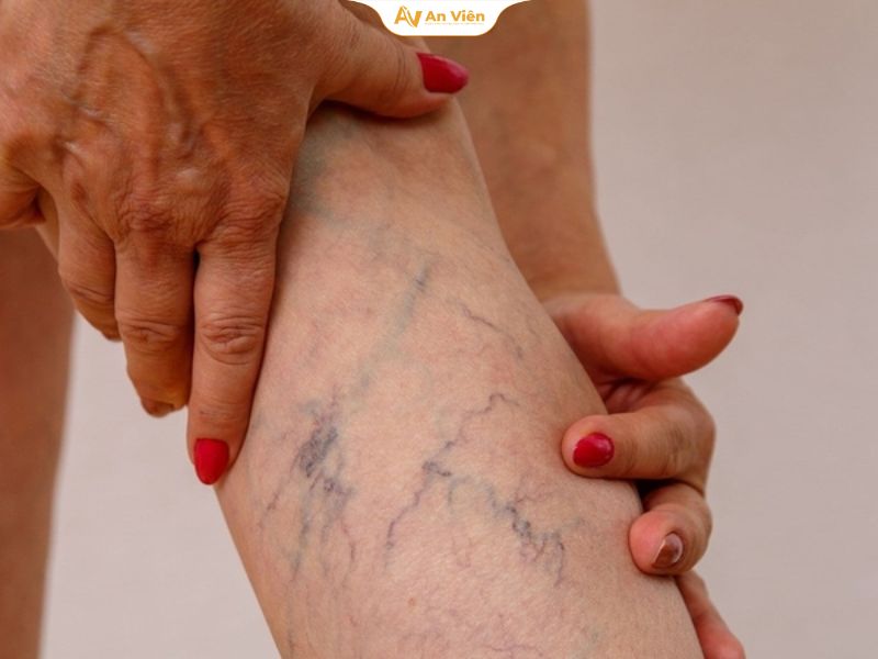 Dấu hiệu huyết khối tĩnh mạch cần nhận biết sớm 14 Huyết khối tĩnh mạch nông