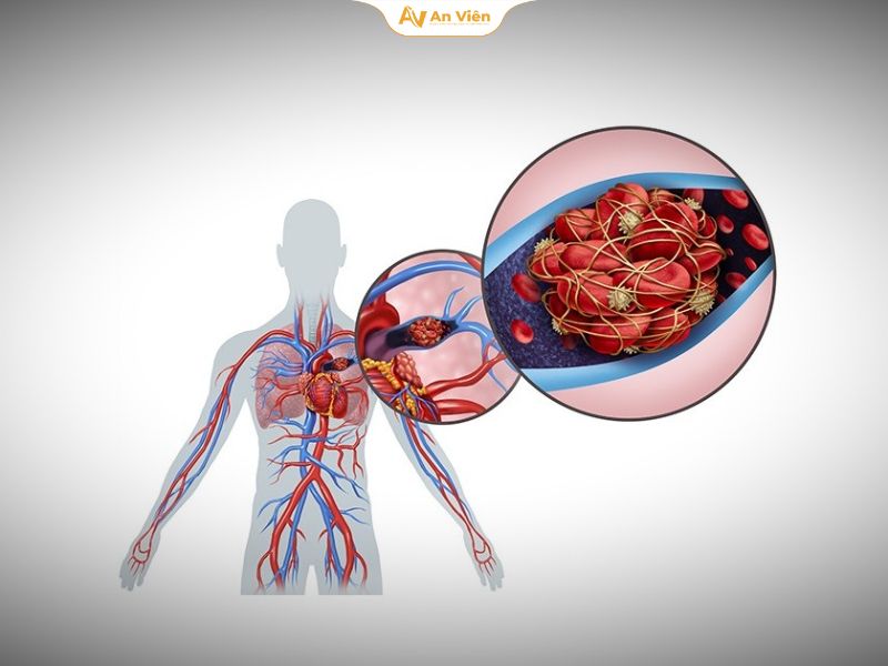 Dấu hiệu huyết khối tĩnh mạch cần nhận biết sớm 16 Thuyên tắc phổi
