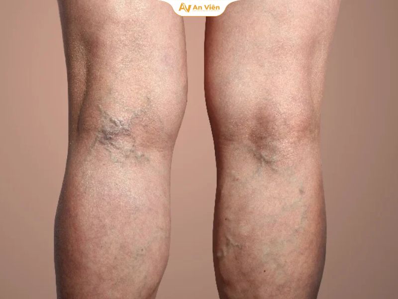 Dấu hiệu huyết khối tĩnh mạch cần nhận biết sớm 12 Sưng một bên chân