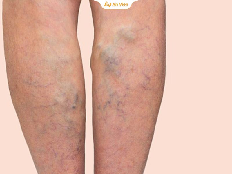 Dấu hiệu huyết khối tĩnh mạch cần nhận biết sớm 19 Phương pháp điều trị huyết khối tĩnh mạch