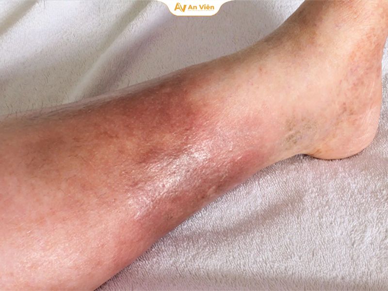 Hiểu đúng về suy giãn tĩnh mạch: Đừng xem nhẹ những dấu hiệu ở đôi chân 10 Vỡ tĩnh mạch có nguy hiểm không?