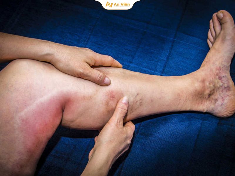 Vỡ tĩnh mạch có nguy hiểm không? Cảnh báo từ bác sĩ chuyên khoa 13 Huyết khối tĩnh mạch sâu (DVT)