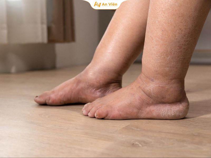 Mùa hè suy giãn tĩnh mạch nặng hơn