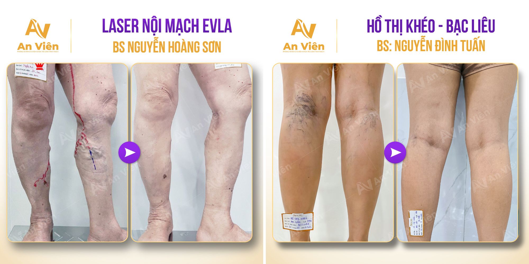 Suy giãn tĩnh mạch 